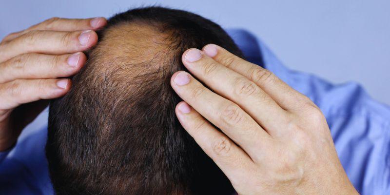 Balding, Thinning, Receding: The Basics of Men's Hair Loss You Should Know